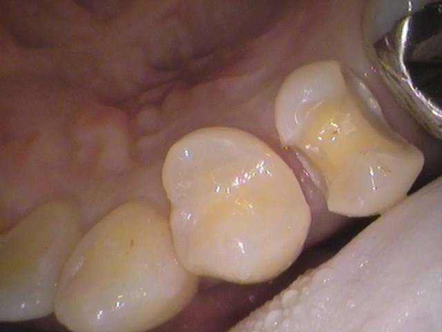 銀歯 虫歯 虫歯 セラミック