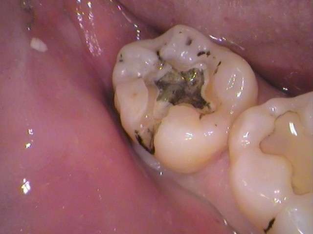 銀歯、虫歯、セラミック