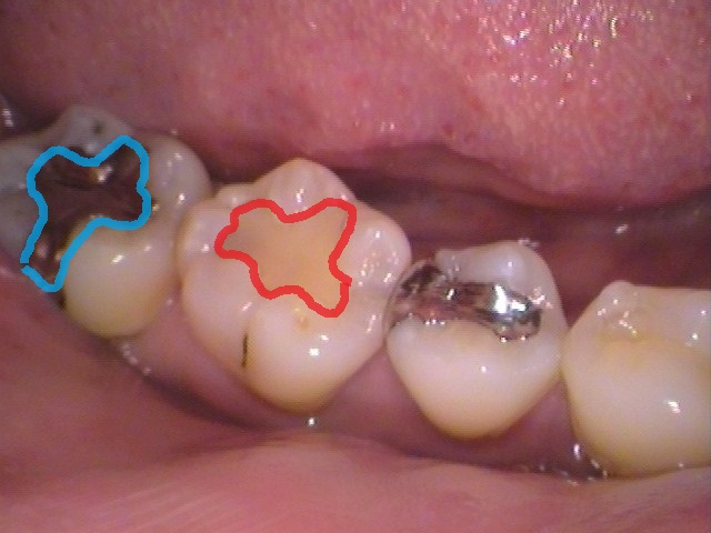 銀歯、虫歯、セラミック