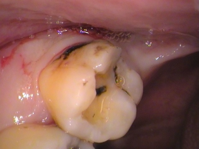 虫歯　セラミック治療　銀歯