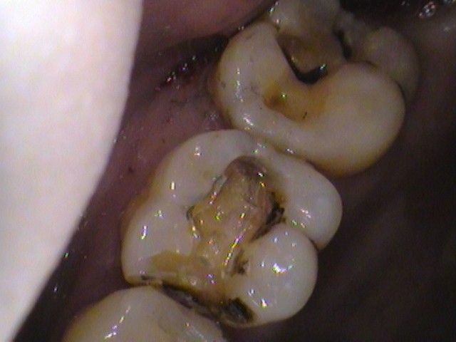 虫歯　セラミック治療　銀歯
