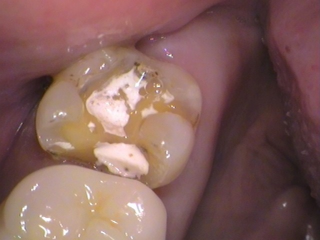 銀歯の中が虫歯　セラミック治療