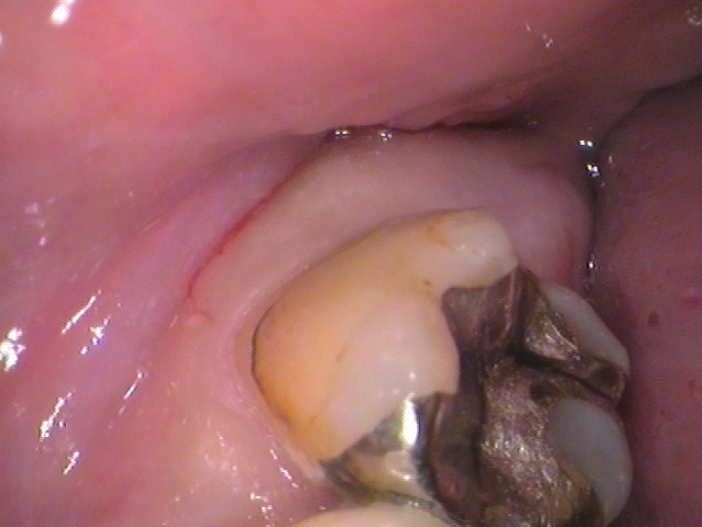 銀歯の中が虫歯　セラミック治療