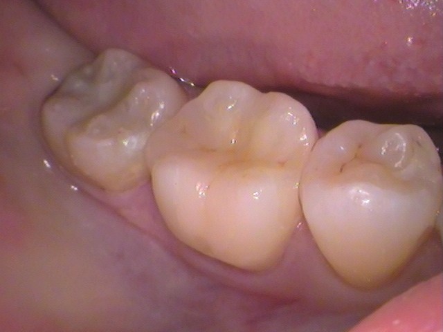 虫歯 セラミック インレー