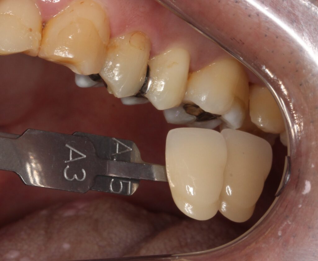 銀歯　歯が欠けた　セラミック治療　自由が丘　歯医者