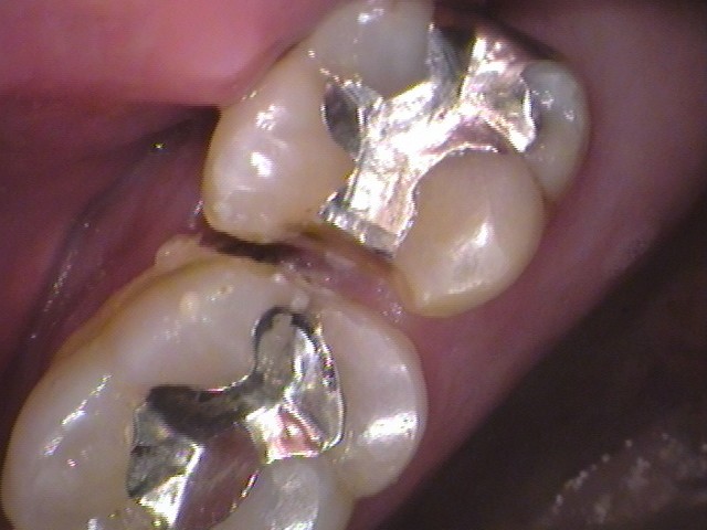 銀歯　歯が欠けた　セラミック治療　自由が丘　歯医者