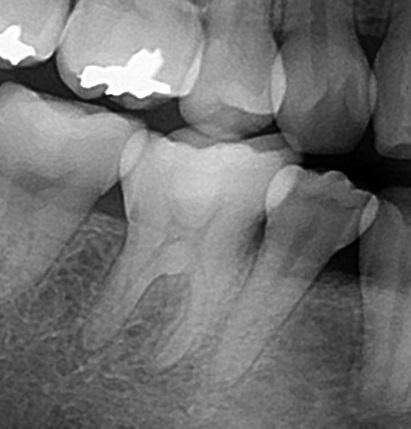 歯の神経保存　MTAセメント　虫歯　歯医者　自由が丘