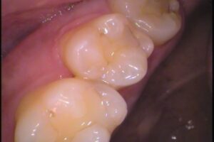 歯の間の虫歯　自由が丘　歯医者