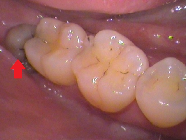 親知らず虫歯　セラミック治療　自由が丘　歯医者