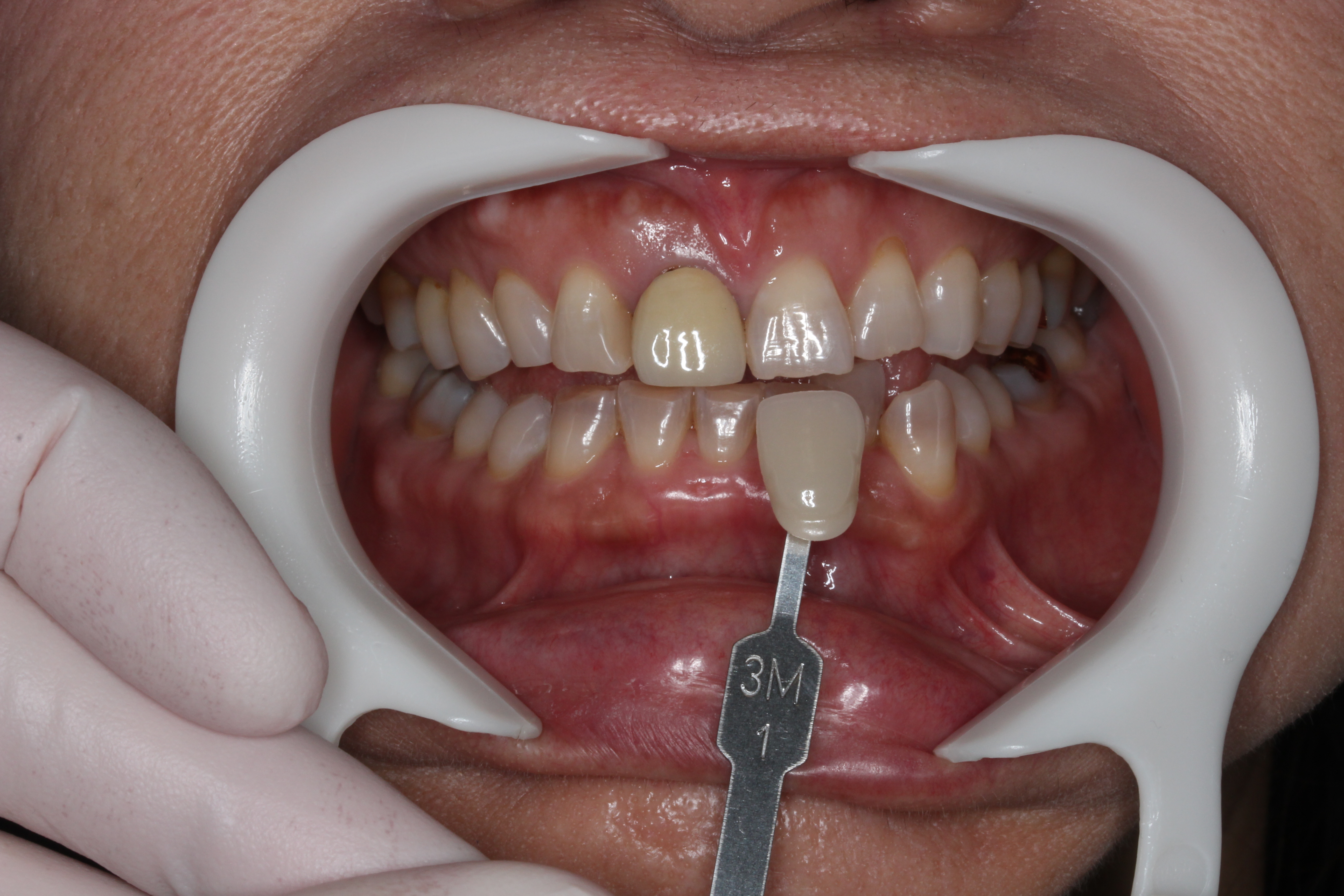 審美歯科　セラミック治療　前歯　自由が丘　歯医者