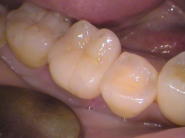 銀歯　セラミックインレー　虫歯　自由が丘　歯医者