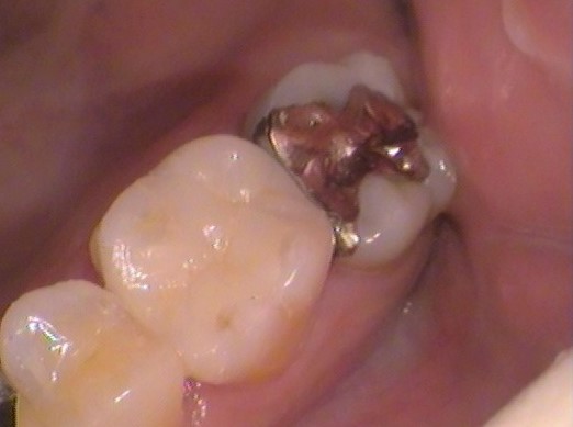 虫歯　治療法　回数　自由が丘　歯医者