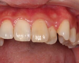 歯の変色　歯の神経　根管治療　自由が丘　歯医者