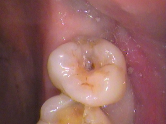 歯の溝虫歯　自由が丘　歯医者　