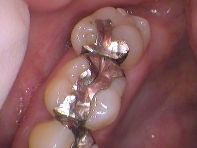 銀歯　虫歯　自由が丘　歯医者