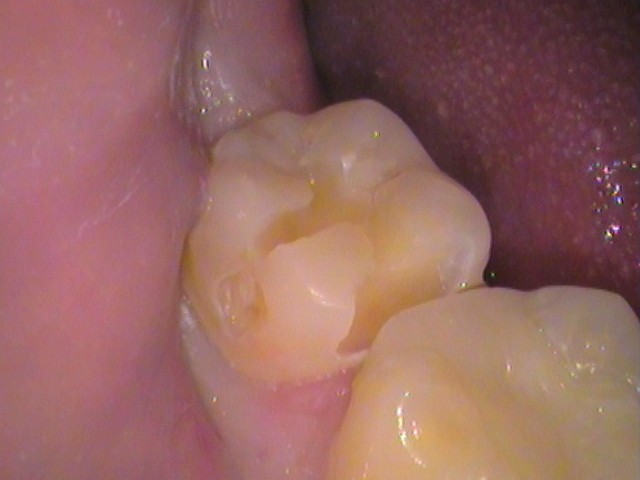 歯の黒い線　虫歯　セラミック　歯医者　自由が丘