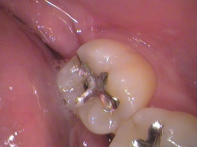 銀歯　虫歯　歯が欠けた　自由が丘　歯医者