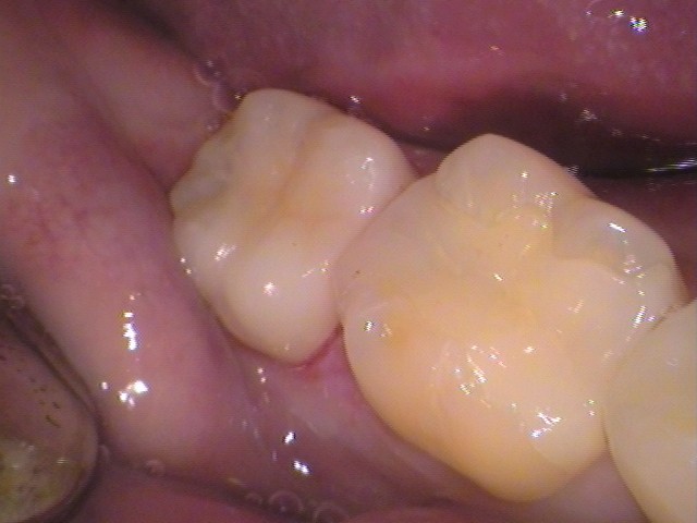 歯の黒い線　虫歯　セラミック　歯医者　自由が丘