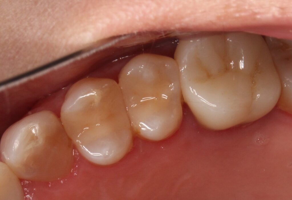 銀歯外れた　虫歯　セラミック　自由が丘　歯医者
