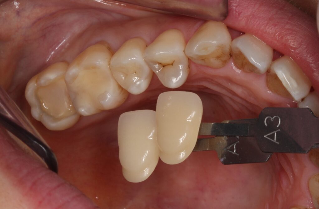 詰め物の下の虫歯　セラミック　自由が丘　歯医者