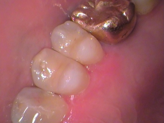 銀歯外れた　虫歯　セラミック　自由が丘　歯医者