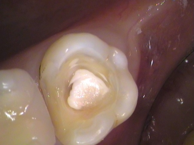 詰め物の下の虫歯　セラミック　自由が丘　歯医者