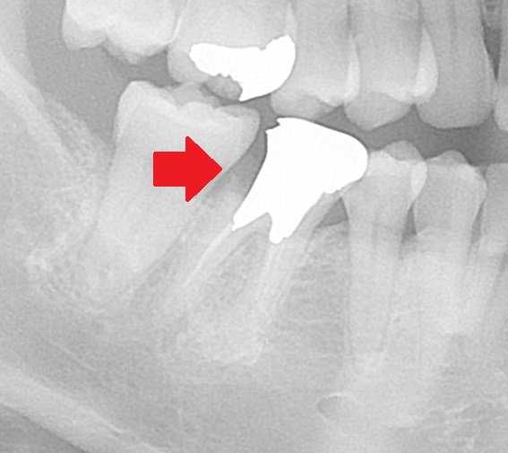 虫歯でボロボロ　虫歯治療　セラミック治療　インプラント治療　根管治療　自由が丘　歯医者