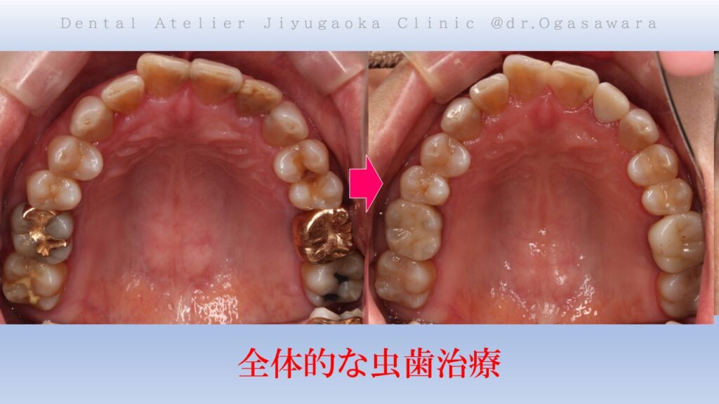 虫歯でボロボロ　虫歯治療　セラミック治療　インプラント治療　根管治療　自由が丘　歯医者