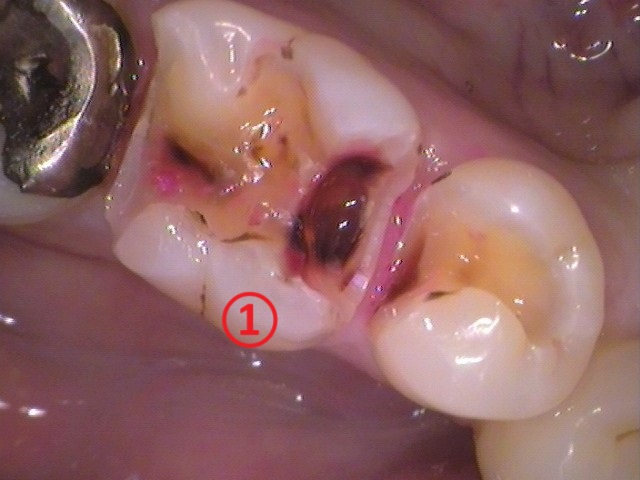 虫歯　分からない　検査　誤診　歯が痛い　銀歯　セラミック