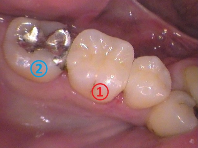 虫歯　分からない　検査　誤診　歯が痛い　銀歯　セラミック