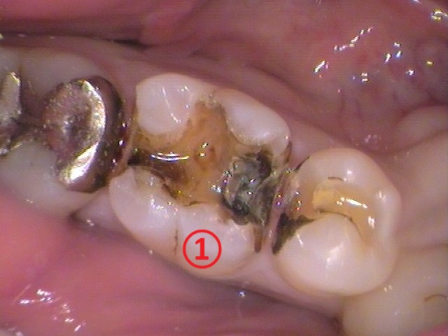 虫歯　分からない　検査　誤診　歯が痛い　銀歯　セラミック