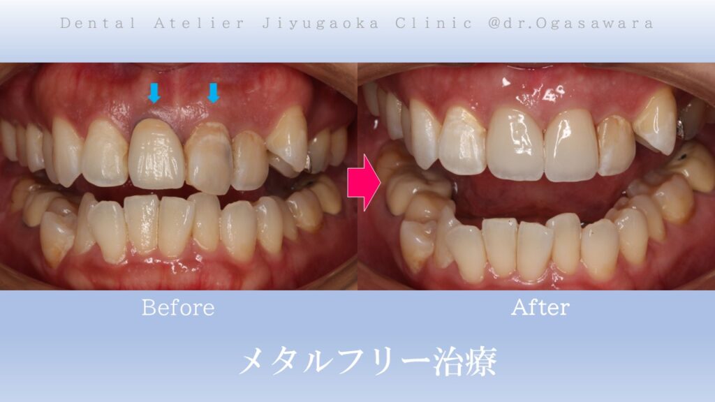 セラミック　前歯　審美歯科　メタルコア　メタルタトゥー