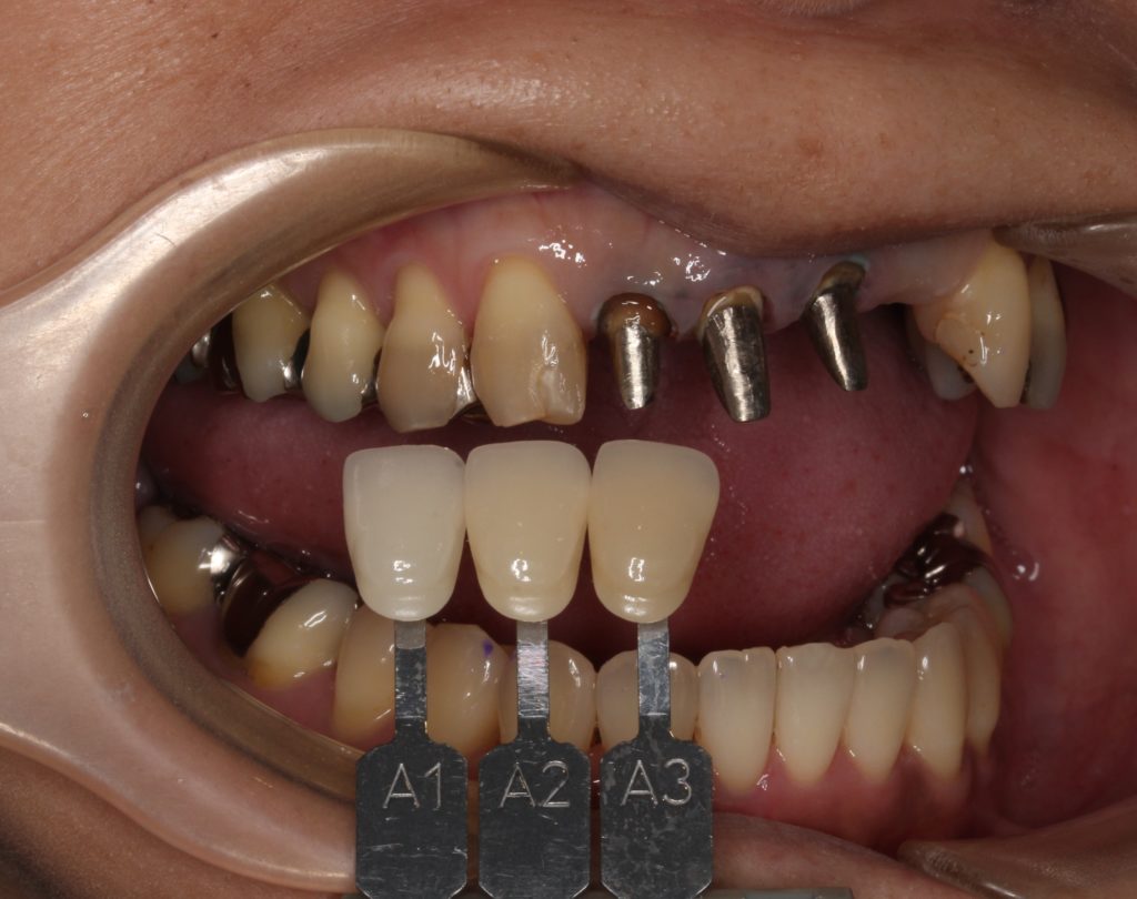 前歯 かぶせ物 クラウン 色が合っていない 形が合っていない セラミック ジルコニア 審美歯科 自由が丘 世田谷 目黒 歯医者 東京 メタルコア