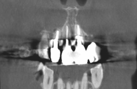 前歯 かぶせ物 クラウン 色が合っていない 形が合っていない セラミック ジルコニア 審美歯科 自由が丘 世田谷 目黒 歯医者 東京