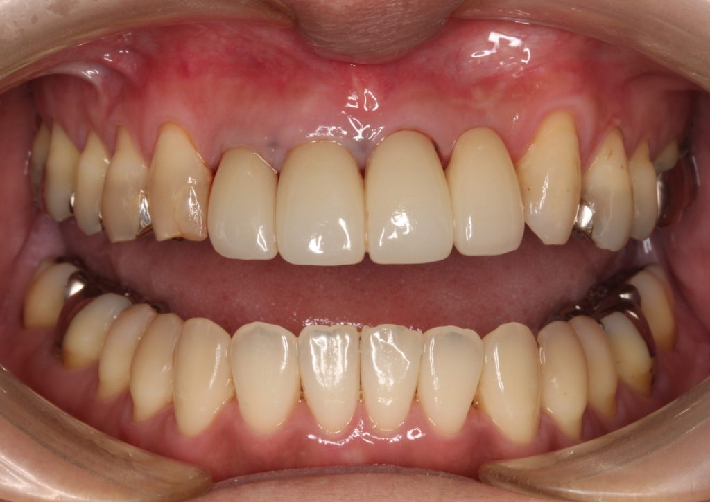 前歯 かぶせ物 クラウン 色が合っていない 形が合っていない セラミック ジルコニア 審美歯科 自由が丘 世田谷 目黒 歯医者 東京