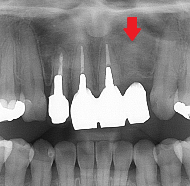 前歯 かぶせ物 クラウン 色が合っていない 形が合っていない セラミック ジルコニア 審美歯科 自由が丘 世田谷 目黒 歯医者 東京