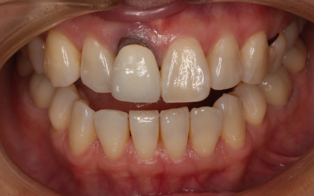 差し歯 歯の根元が黒い メタルタトゥー 審美歯科 セラミックの歯 自由が丘 歯医者 差し歯やり変え