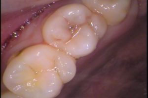 虫歯　歯医者　自由が丘