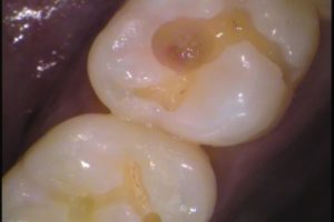 虫歯　歯医者　自由が丘