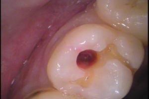 虫歯　歯医者　自由が丘