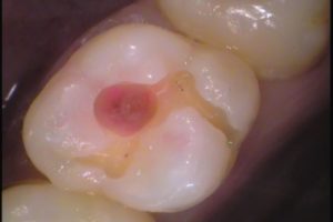 虫歯　歯医者　自由が丘