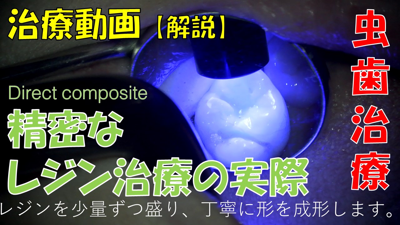 虫歯治療　動画