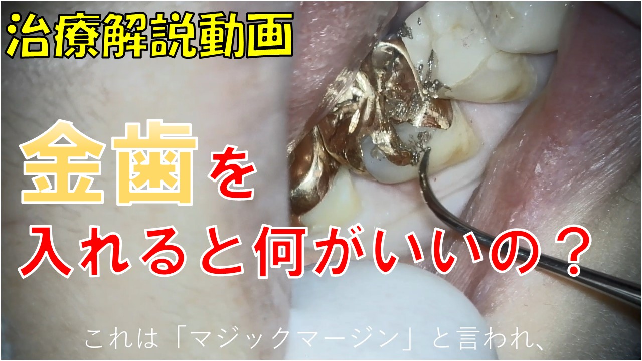 金歯　ゴールドインレー