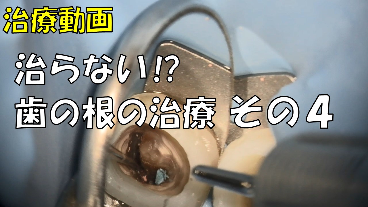 根管治療　マイクロスコープ　ラバーダム