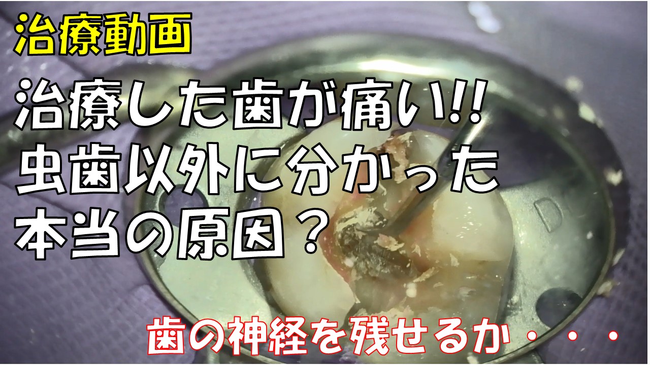 歯の亀裂　むし歯治療　動画