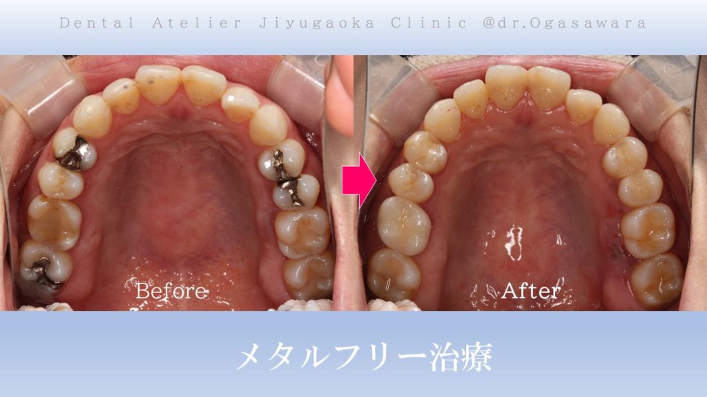 上顎：銀歯とレジン術前術後