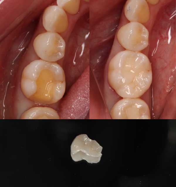 セラミックインレーが入った状態