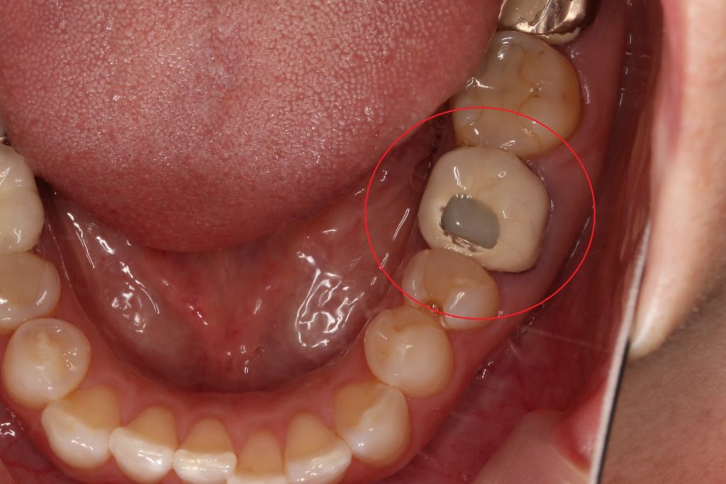 根の先が膿んだ被せ物