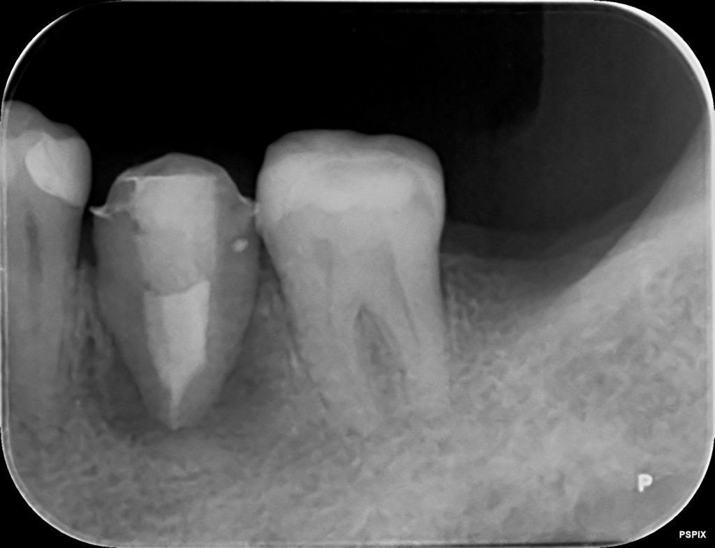 移植・根管治療終了3か月後