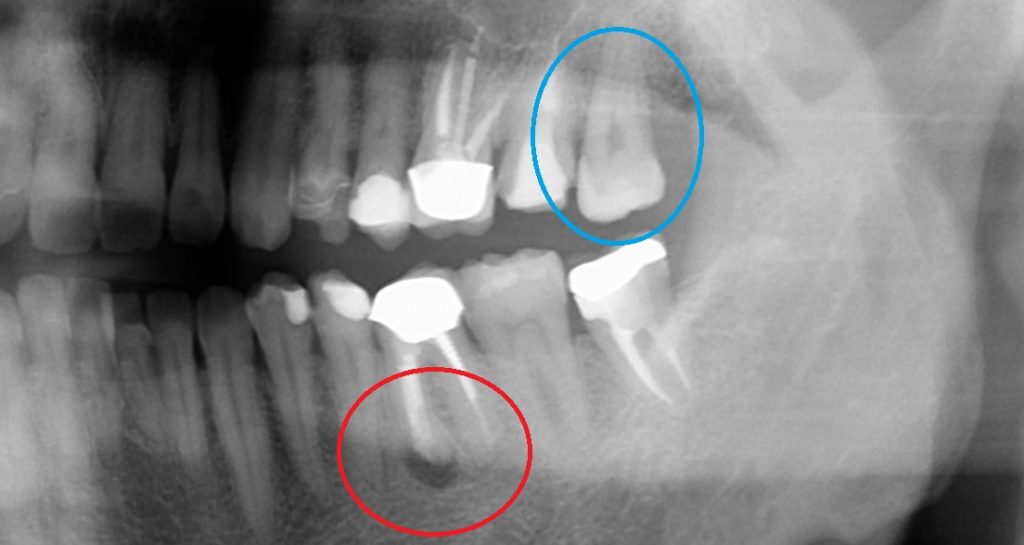歯の根っこに黒い像レントゲン
